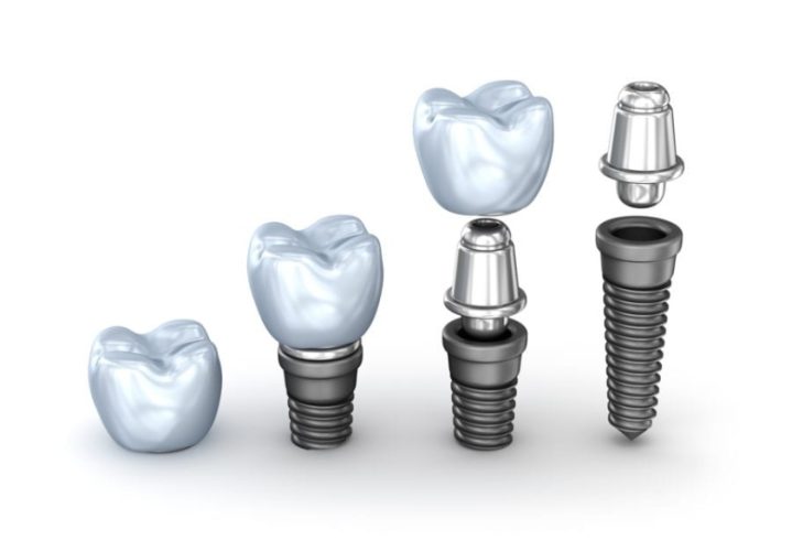 Vật liệu cấy ghép đều an toàn, lành tính với cơ thể