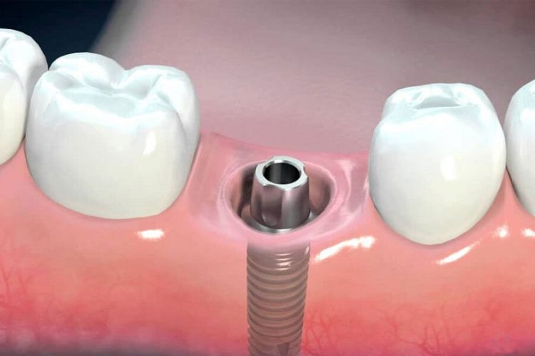 Trụ Implant được cấy ghép vào xương hàm ngay sau khi nhổ răng