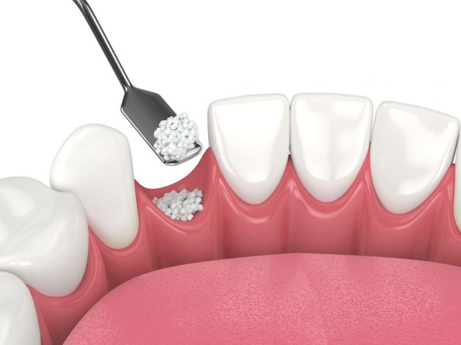 Trong một số trường hợp thiếu xương hàm, khách hàng có thể cần ghép thêm xương trước khi đặt Implant