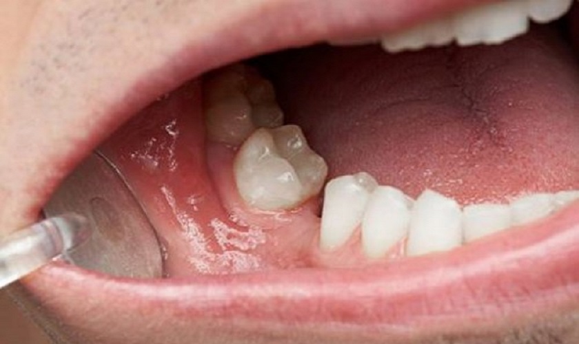 Răng nghiêng vào vùng mất răng có cấy Implant được không?