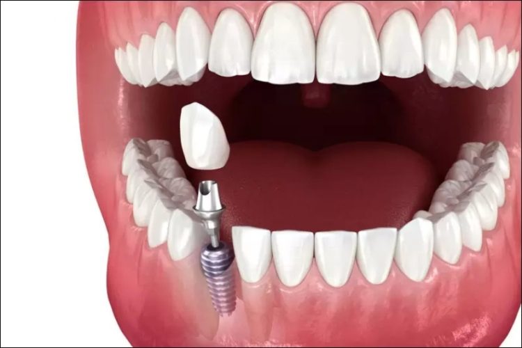 Trồng răng Implant