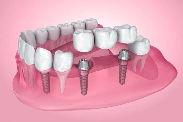 Trồng răng Implant
