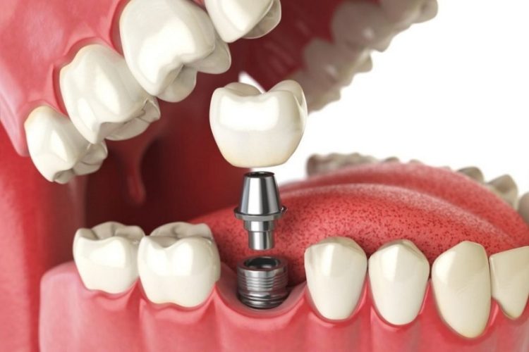 Kỹ thuật trồng răng Implant