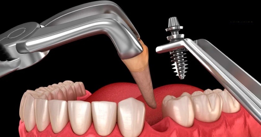 Trồng răng Implant tức thì