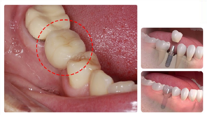 Răng tạm trên Implant có màu sắc và hình dạng tương tự răng thật