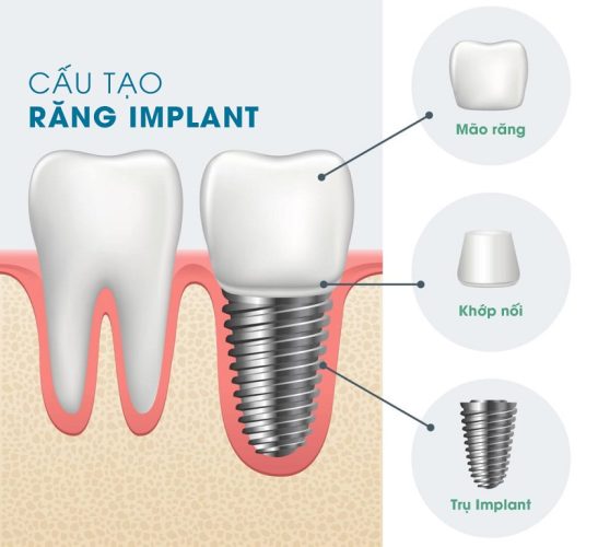 Răng Implant sau khi hoàn thiện sẽ có cấu trúc tương tự với răng thật