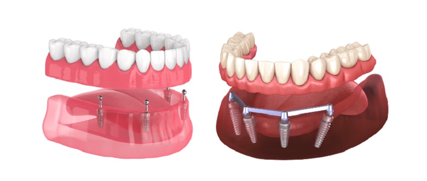 Các loại hàm phủ trên Implant