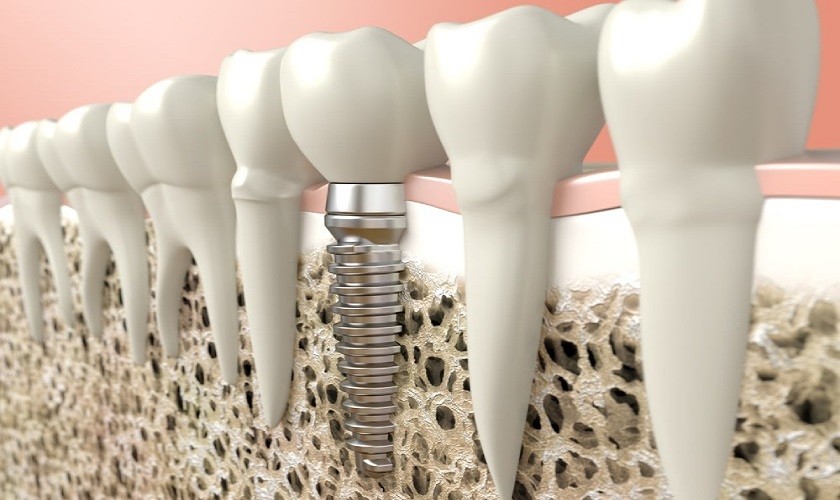 Trồng răng bằng phương pháp Implant là gì? Ở đâu tốt?