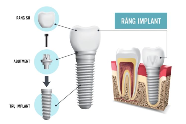 Các thành phần cấu tạo chính của một chiếc răng Implant