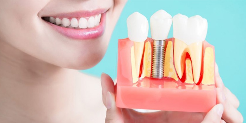 Trồng răng bằng phương pháp Implant đem lại nhiều lợi ích vượt trội