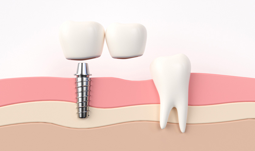 Trồng răng Implant bị lung lay có nguy hiểm không?