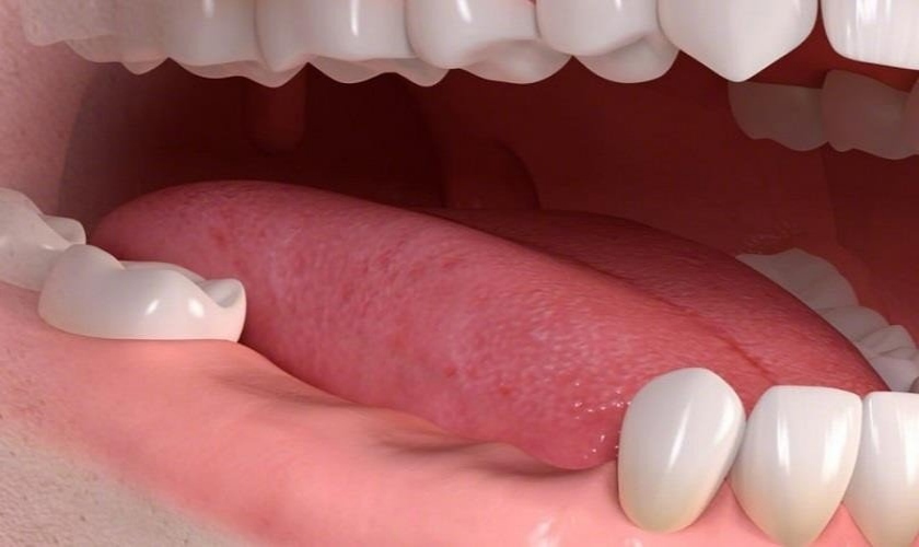 Trồng răng Implant có giúp cải thiện hệ tiêu hóa