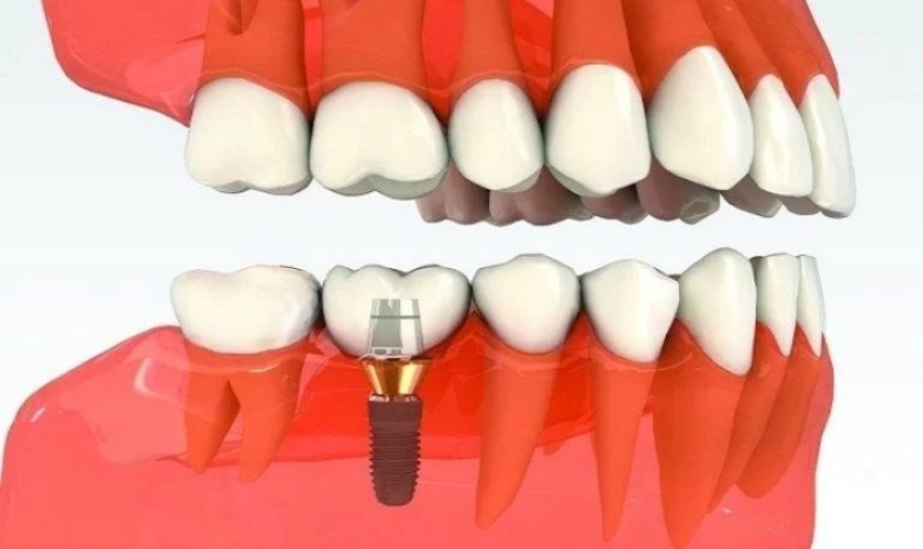 Trồng răng Implant giải pháp ngăn ngừa tiêu xương hàm hiệu quả