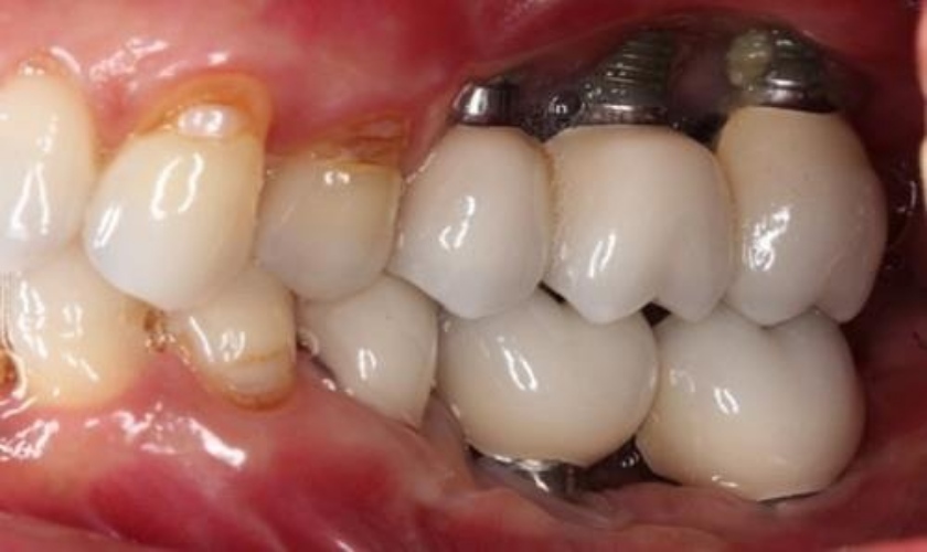 Trồng răng Implant giá rẻ