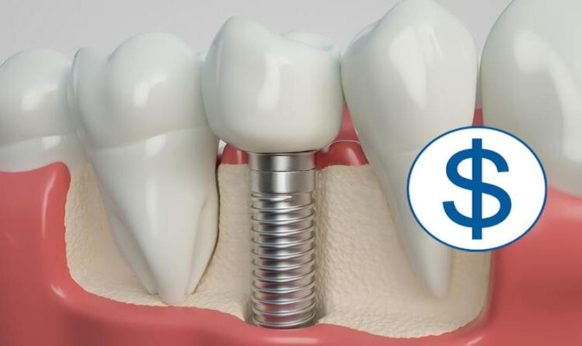 Giá trồng răng Implant trọn gói