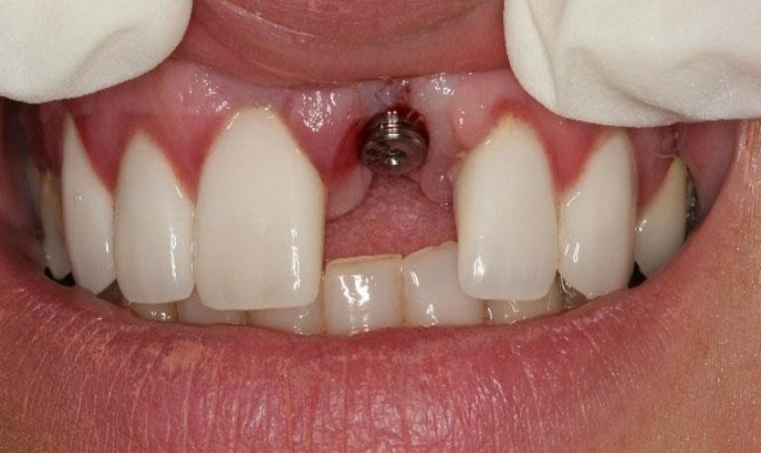 Nguyên nhân trồng răng Implant thất bại