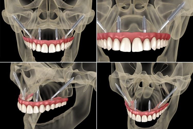 Implant xương gò má là gì?