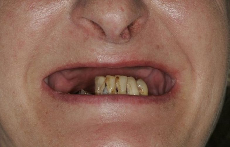 Trồng răng Implant vào xương gò má được chỉ định trong trường hợp mất răng hàm trên và xương hàm tiêu biến nhiều