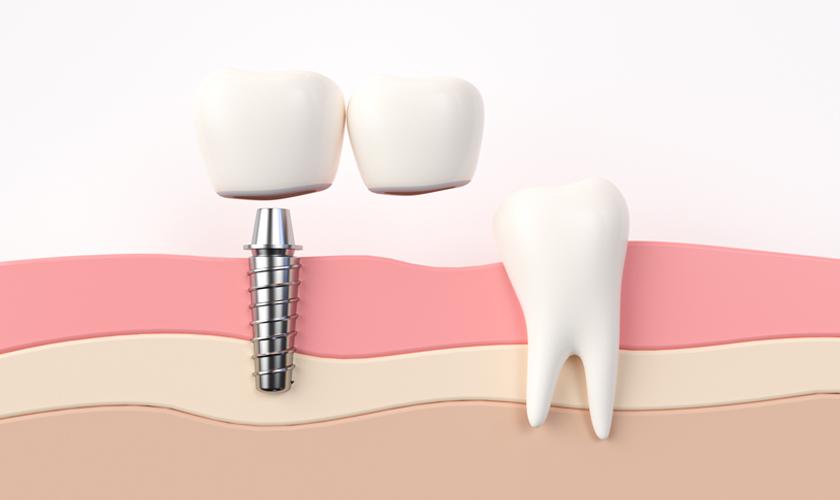 Tiết kiệm chi phí trồng răng Implant với Implant Center