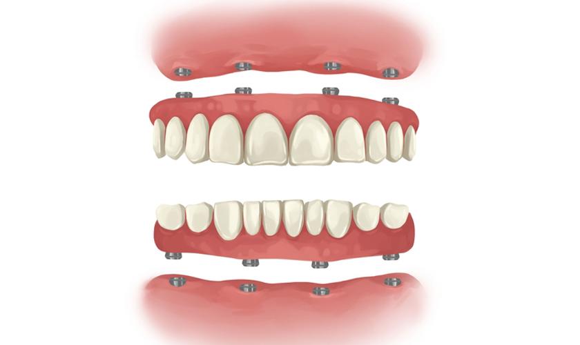 Bảng giá cấy răng Implant toàn hàm