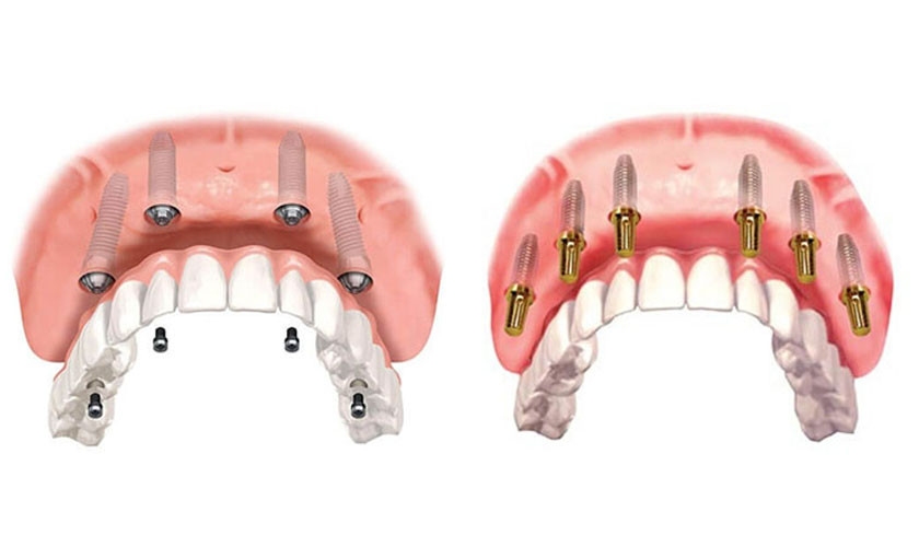 Kỹ thuật Implant All On 4 và All On 6