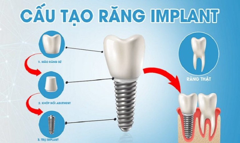 Cấu tạo răng Implant
