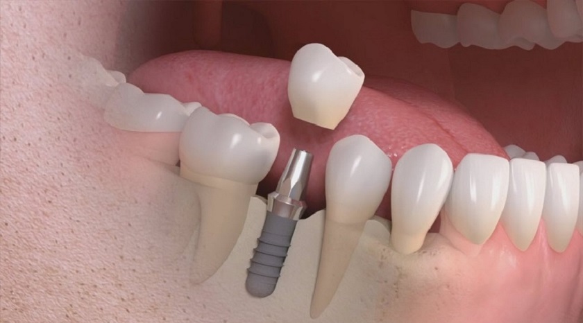 Răng tạm trên Implant