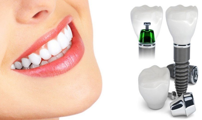 Trồng răng Implant phương pháp khôi phục răng mất cho bị nghiến răng hiệu quả