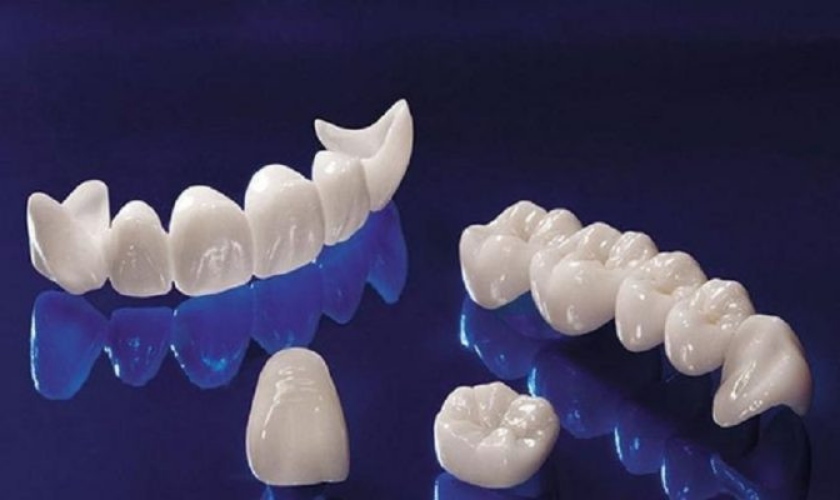 Răng sứ trên Implant nào tốt nhất