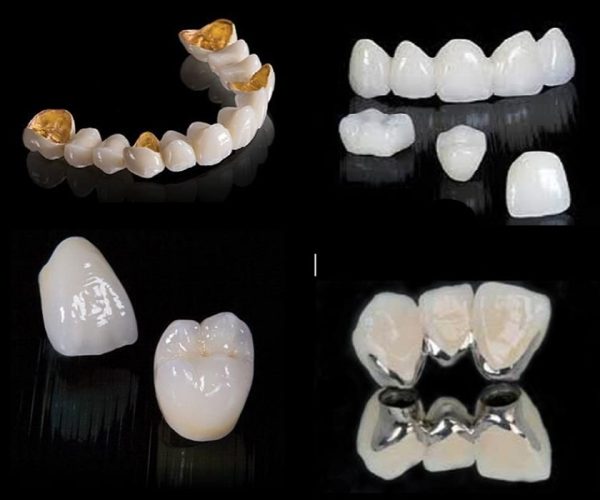 Răng tạm trên Implant có thể được làm từ nhựa, sứ hoặc kim loại