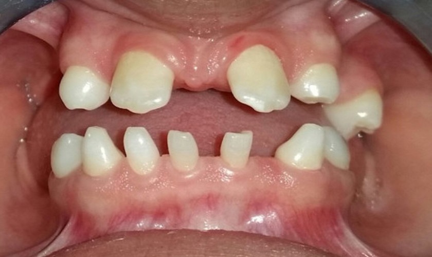 Trẻ em mất răng bẩm sinh có cấy ghép Implant được không?