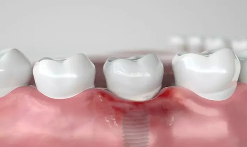 Trồng răng giắt thức ăn ảnh hưởng đến sức khoẻ răng miệng