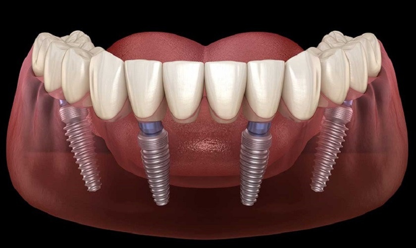 Trồng răng Implant All On 4 giá bao nhiêu