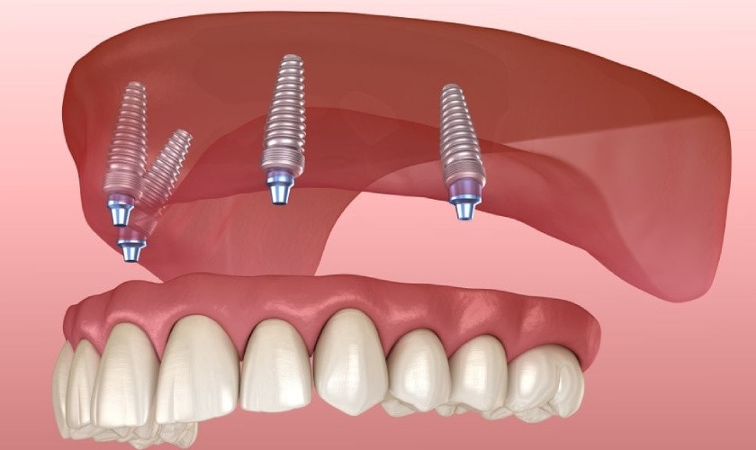 Trồng răng Implant All On 4 giúp tiết kiệm chi phí tối ưu