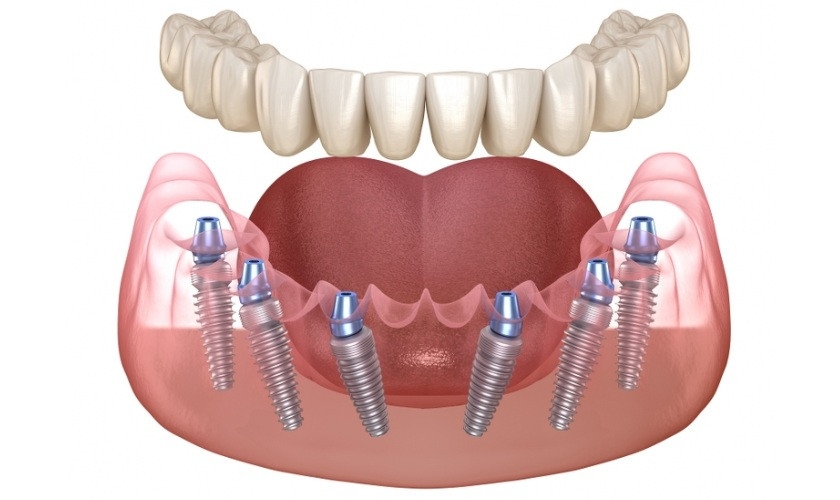 Trồng răng Implant All On 6