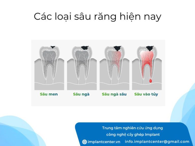 Sâu răng là hiện tượng gì? Nguyên nhân, các giai đoạn và cách điều trị ...