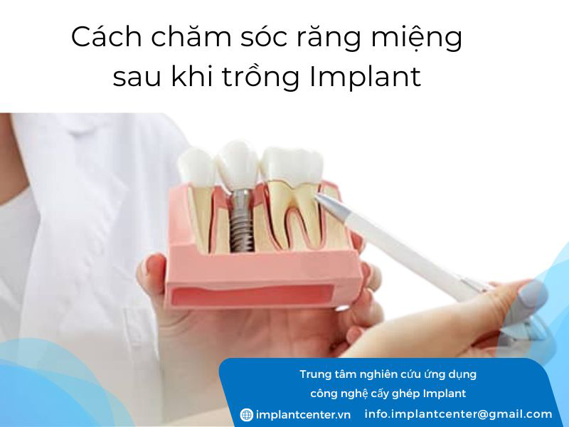 Cách chăm sóc răng miệng đúng cách sau khi trồng răng Implant
