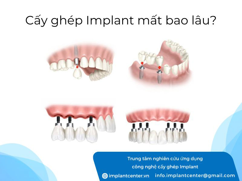 Cấy ghép implant mất bao lâu