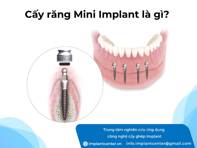 Cấy răng Mini Implant là gì