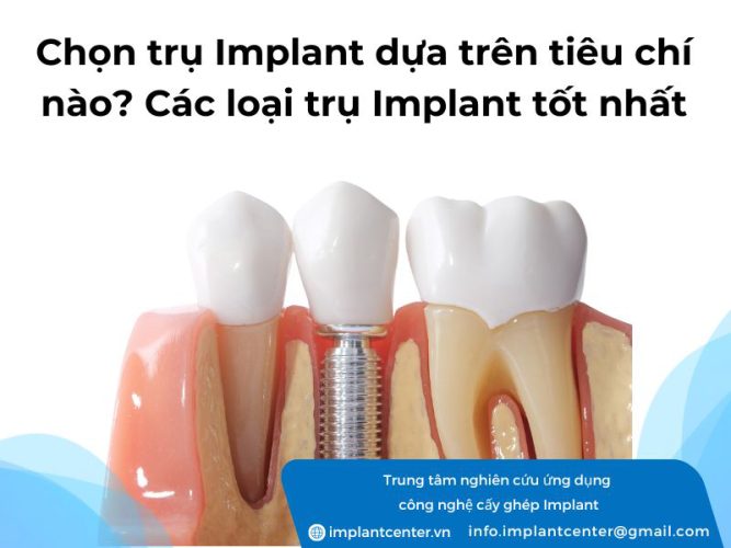 Chọn trụ Implant dựa trên tiêu chí nào? Các loại trụ Implant tốt hiện nay