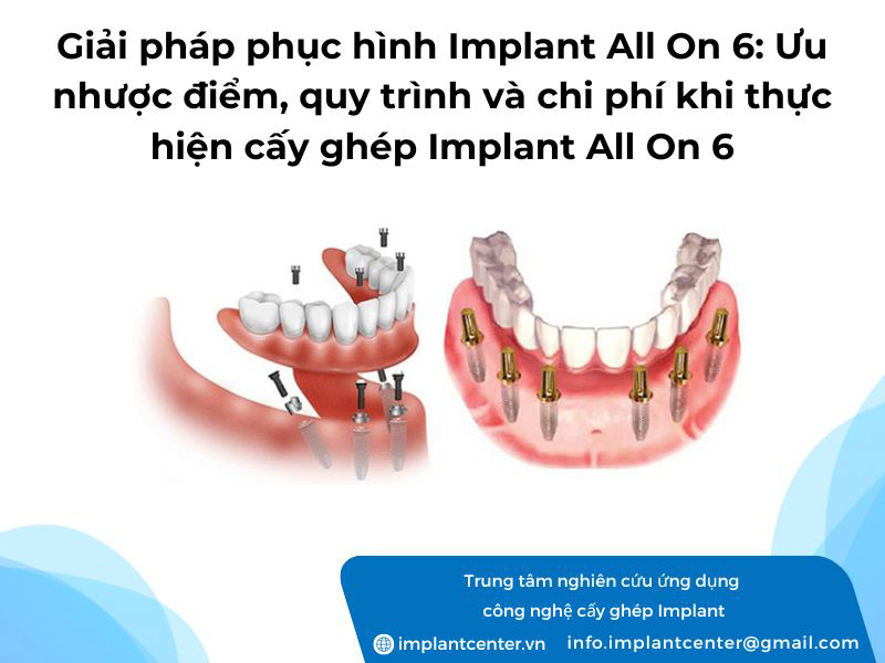 Giải phép phục hình Implant All On 6: ưu nhược điểm, quy trình và chi phí khi thực hiện cấy ghép Implant All On 6