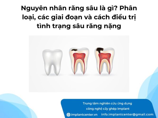 Nguyên nhân răng sâu là gì? Phân loại các giai đoạn và các điều trị tình trạng răng sâu nặng