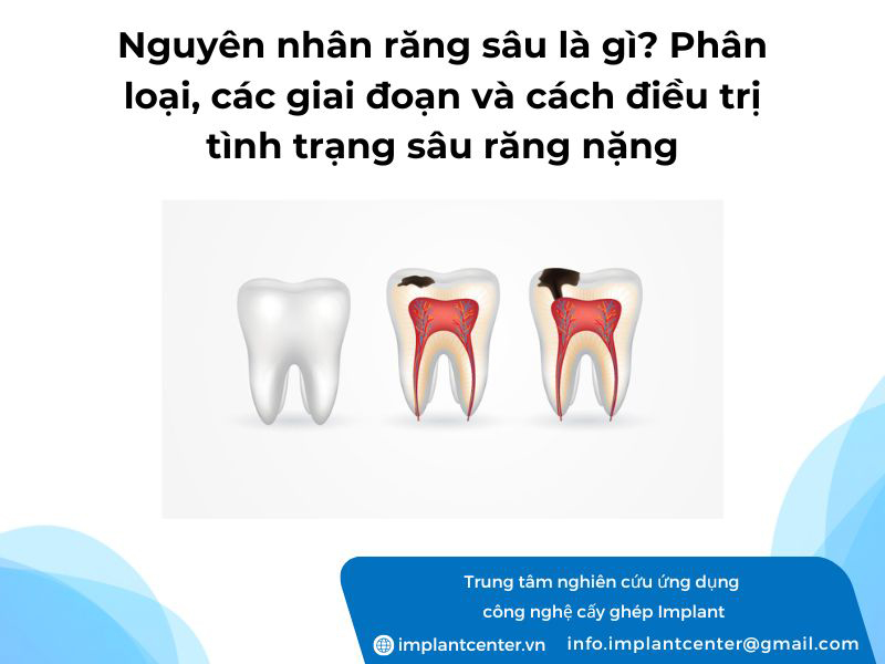 Nguyên nhân răng sâu là gì? Phân loại các giai đoạn và các điều trị tình trạng răng sâu nặng