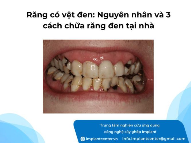 Răng có vệt đen: Nguyên nhân và 3 cách chữa răng đen tại nhà