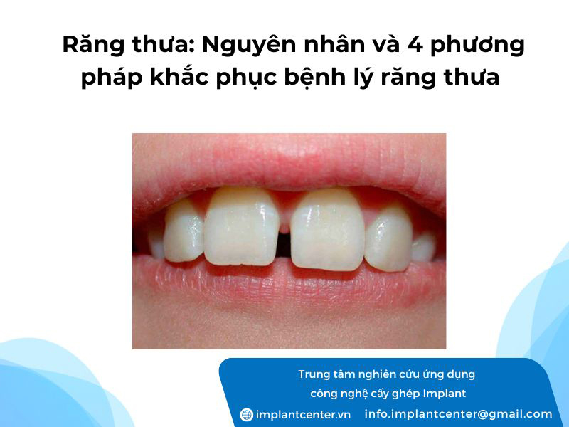 Nguyên nhân và 4 phương pháp khắc phục bệnh lý răng thưa hiệu quả