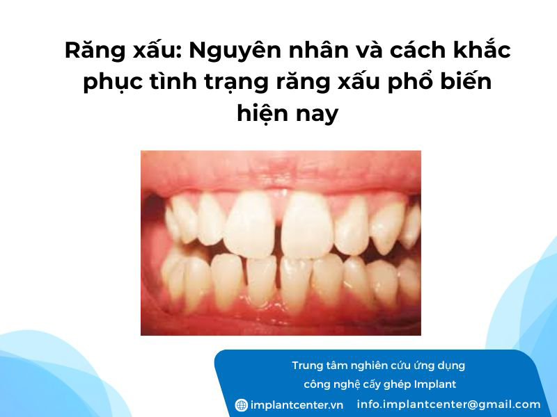 Nguyên nhân và cách khắc phục tình trạng răng xấu phố biến hiện nay