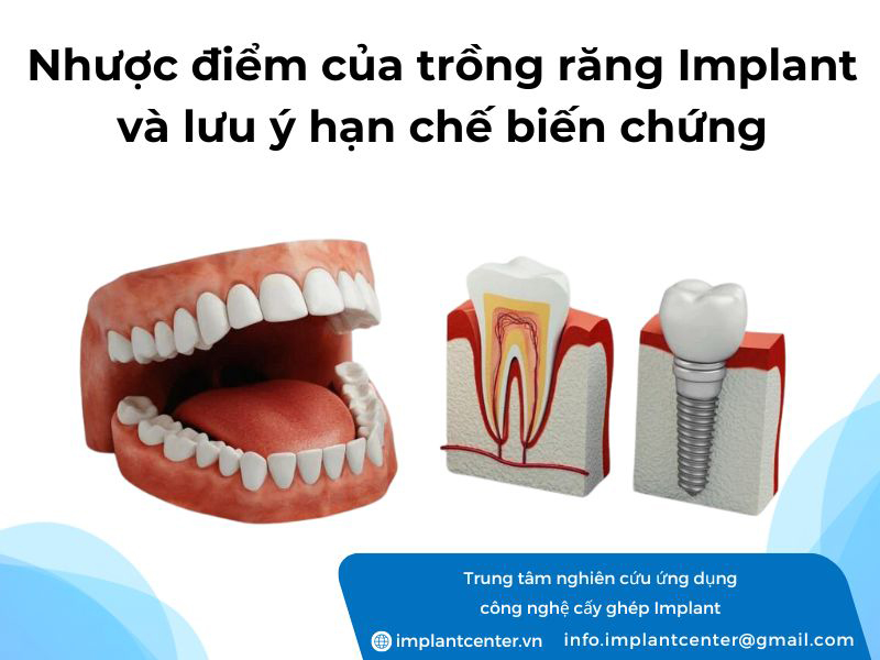 Nhược điểm của trồng răng implant và lưu ý hạn c