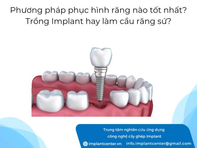 Phương pháp phục hình răng nào tốt? Trồng Implant hay làm cầu răng sứ