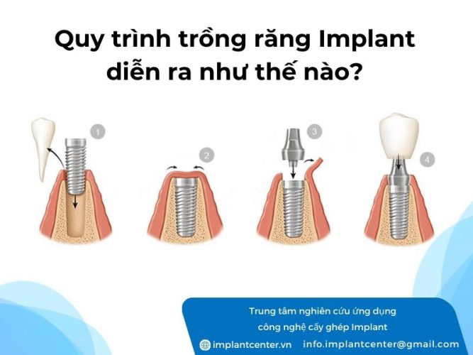 Quy trình trồng răng implant diễn ra như thế nào