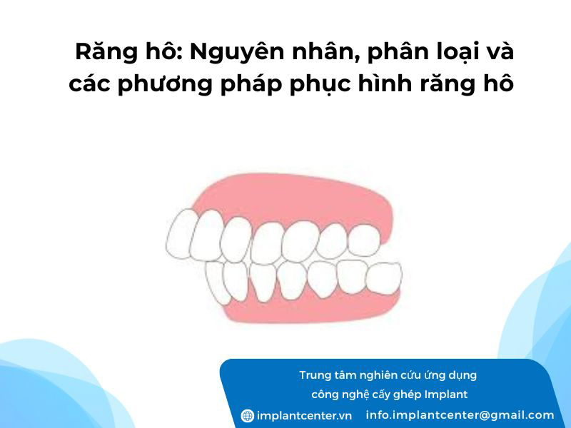 Răng hô nguyên nhân phân loại và các phương pháp phục hình răng hô hiện nay